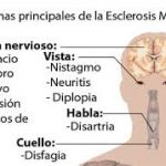 Esclerosis multiple